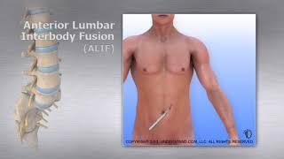 Lumbar   Anterior Lumbar Interbody Fusion ALIF