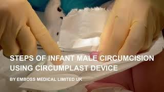 Infant male circumcision with Circumplast device- Best ring