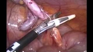 Laparoscopic Appendectomy