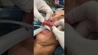 Silicone lip implant removal