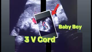 37, 10 & 31 weeks anterior placenta baby Boy scan report | Anterior placenta means baby boy or girl