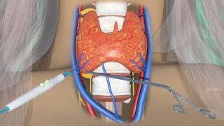 3D Medical animation Parathyroidectomy Cure with Minimally Invasive surgery