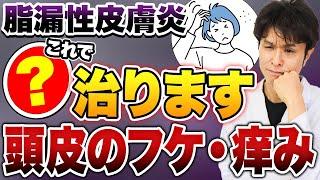 頭のフケやかゆみ、それは病気のサイン？！脂漏性皮膚炎の原因と効果的な治療法