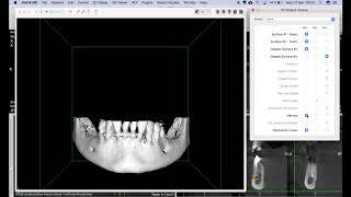 Dental3DPlugin 3.1.0 - CBCT 3D Surface fast clipping