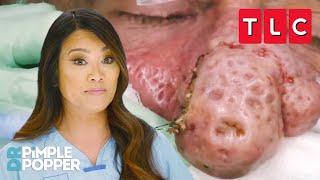 Bumpiest Nose Growths | Dr. Pimple Popper | TLC