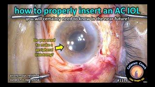 CataractCoach 1179: how to insert an AC IOL (anterior chamber IOL)