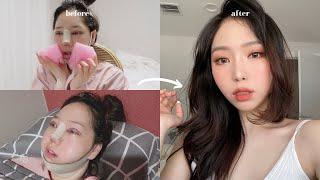 MY PLASTIC SURGERY EXPERIENCE IN KOREA (PTOSIS CORRECTION, NOSE, LIPOSUCTION, BOTOX)