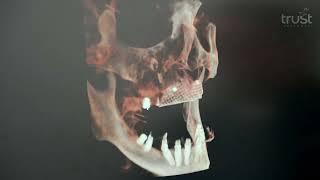 No bone no problem, part 2: Case planning and surgery for the complicated implant restoration