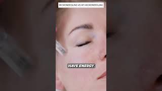  MICRONEEDLING Vs RF MICRONEEDLING  What You Can Expect