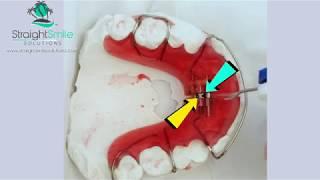 How to Turn your Schwartz or RPE Expander https://www.straightsmilesolutions.com/