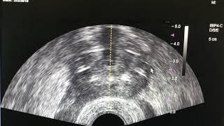 AUA Urology Teaching Video: Prostate Cryoablation: Techniques for Safe and Effective Therapy