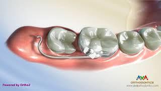 Orthodontic Treatment for Molar Uprighting - Halterman Appliance