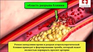 Ишемическая болезнь сердца и стенокардия: механизм, локализация боли и причина инфаркта миокарда
