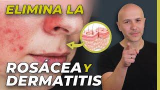 Rosácea Y Dermatitis: Así Se Cura | Dr. Carlos Jaramillo