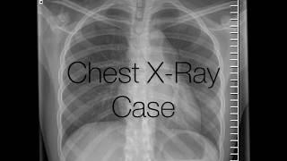 Aortic Dissection Radiology Xray and CT