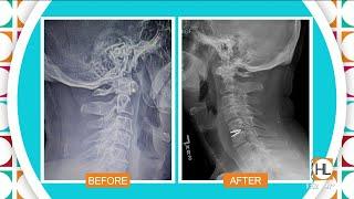 Neck and back treatment options at Houston Physicians’ Hospital | HOUSTON LIFE | KPRC 2