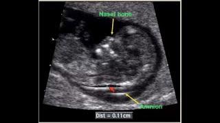 Fetal anomalies at first trimester by Ultrasound