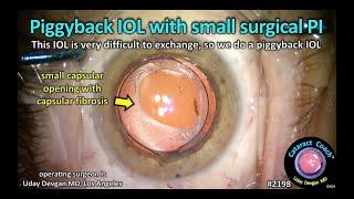 CataractCoach™ 2198: piggyback IOL with small surgical PI peripheral iridotomy