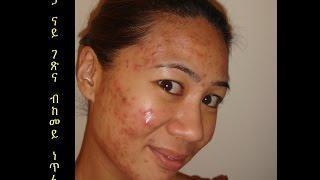 ናይ ገጽና ፈጸጋ ከመይ ጌርና ነጥፈኦ Helena Beauty Treatment - Part 3 - How To Get Rid Pimple / Black Spot