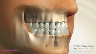 Bone Anchored Maxillary Protraction - Orthodontic Treatment