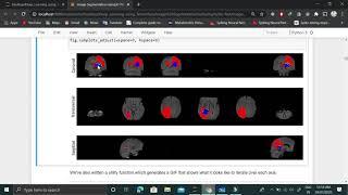 Brain Tumor detection based on MRI Image Segmentation using U-Net from Scratch in Tensorflow