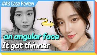 [Plastic Surgery in Korea] The reason why her face got slimmer│review of plastic surgery