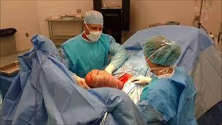 All About Colic Surgery
