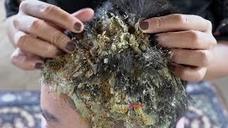 Dandruff Combing Of Big Flake!! | The Itchy Scalp Of Dandruff Removal #101