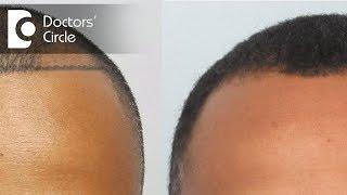 What is graft & follicle in Hair Transplantation? - Dr. Girish A C | Doctors' Circle