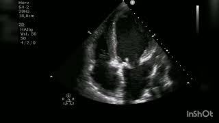 very severely reduced left ventricle and right ventricular function with septal dyskinesia