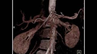 Abdomen: Pancreas: Staging of pancreatic cancer:Analysis of arterial and venous structures(2 of 11)