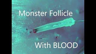Follicle Hair Pluck 27: Monster Follicles