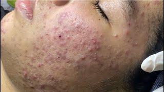 Acne treatment for Spa Linh Mun 2024 #60