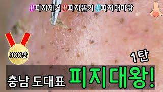 피지 직접 뽑아드렸습니다 _ 피지제거 블랙헤드제거 피지뽑기 _ 충남 도대표 남자구독자님! 피지제거 현장속으로 빠져봅시다! 기대만빵 1탄 시작합니다