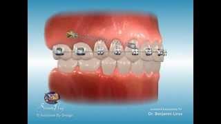 ScreenPlay Orthodontic Education Videos: Temporary Anchorage Devices (TADs)