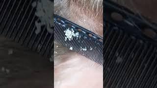 dandruff scratching addiction #84