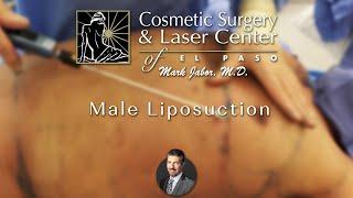Male Liposuction Abdomen, Chest & Flanks - Dr. Mark Jabor