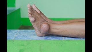 Gout: Symptoms, causes, Diet and treatment by Dr. Lakshmy, Nisarga Hospital.