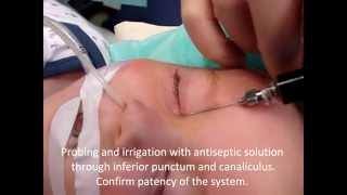 Lacrimal system probing in Children. Dr. H. Aral
