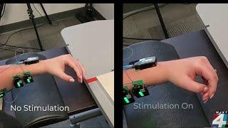 Neurotechnology instantly helps stroke patients move