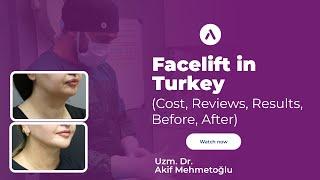 Facelift in Turkey (Cost, Reviews, Results, Before, After)
