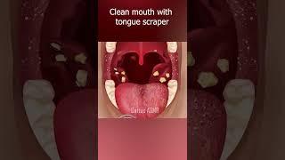 ASMR Remove tonsil stones super eye-catching Wait For End  #shorts #satisfying