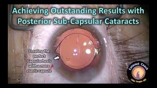 Best Technique for Posterior SubCapsular Cataract Surgery in younger patients