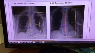 Scoliosis correction using Scolibrace