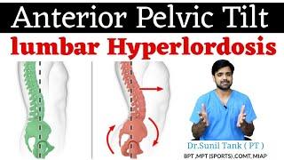 correction exercises for lumbar hyperlordosis (anterior pelvic tilt ) in hindi | Physiopoint