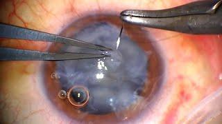 Traumatic Cataract Surgery: Corneal Laceration & Ruptured Capsule - step-by-step surgical technique
