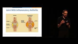 Joint Matters at Work - What is Arthritis?