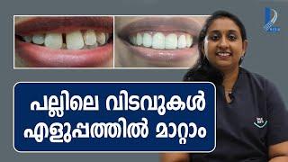 പല്ലിലെ വിടവുകൾ എളുപ്പത്തിൽ മാറ്റാം | CLOSE GAP TEETH | Dr. Anisha P John | Smile Kochi |L Bug Media