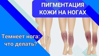 ТЕМНЕЕТ НОГА: что делать?