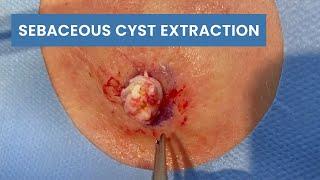 Sebaceous Cyst Extraction | CONTOUR DERMATOLOGY